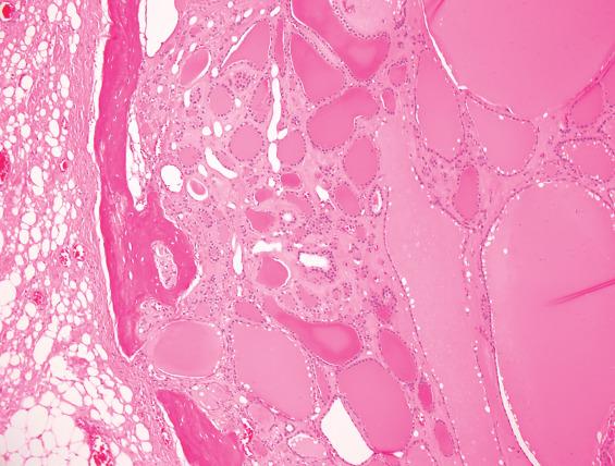 FIGURE 23.6, Ectopic thyroid tissue is present within the hyoid bone and should not be mistaken for metastatic carcinoma.