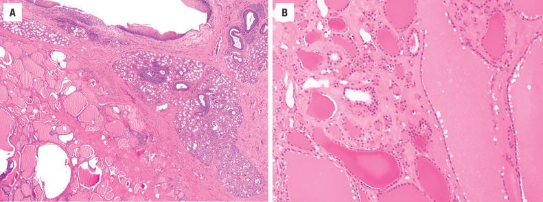 FIGURE 23.7, A, Ectopic thyroid tissue is present beneath the surface mucosa ( top ) of the base of tongue in lingual thyroid. B, The thyroid parenchyma is histologically identical to the normal thyroid gland.