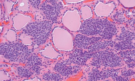 FIGURE 23.8, The ultimobranchial body remnant is a solid cell nest, adjacent to normal thyroid parenchyma, and is an incidental finding. It often consists of multiple solid, round nests of cells that appear to encase and replace thyroid follicles.