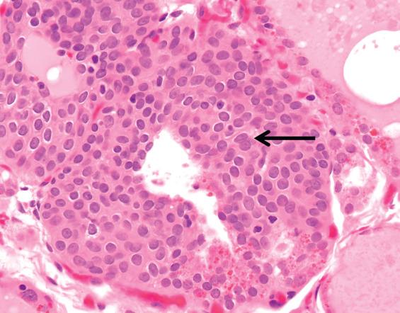 FIGURE 23.9, The ultimobranchial body epithelium is reminiscent of immature squamous metaplasia. Note the lack of keratinization and intercellular bridges. The nuclei are ovoid, often with a longitudinal groove ( arrow ).