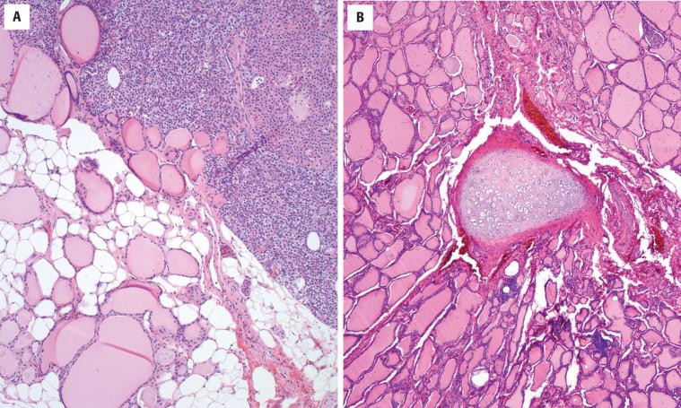 FIGURE 23.10, There may be inclusions of other tissue types identified within the thyroid gland. Here is an intrathyroidal parathyroid ( A ) and a small fragment of cartilage ( B ).