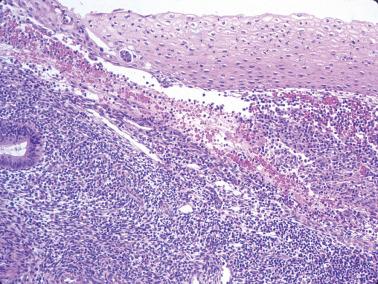 Fig. 7.11, Squamous (non-morular) metaplasia. Mature squamous epithelium is present in a plaque-like manner on the surface of the endometrium.