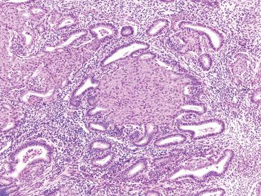 Fig. 7.12, Squamous (morular) metaplasia. The classic rounded shape of morular metaplasia is seen centrally.