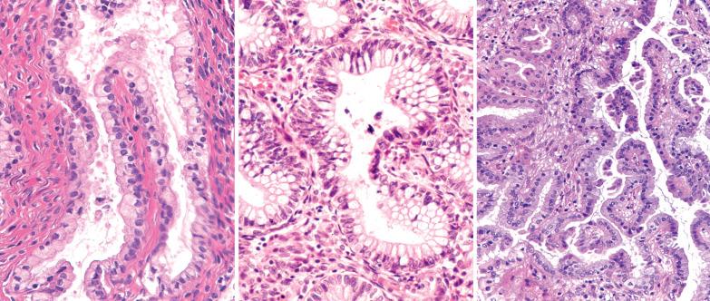 Fig. 7.13, Mucinous metaplasia, three different cases. Left: A gland within a typical endometrial polyp that is lined by a single layer of bland endocervical-like epithelium. Center: Mucinous metaplasia, intestinal type. Goblet cells line the endometrial glands. Right: Papillary mucinous metaplasia (see text).