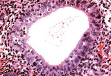 Fig. 7.14, Ciliated (tubal) metaplasia. An endometrial gland is lined predominantly by ciliated cells.