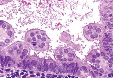 Fig. 7.15, Ciliated (tubal) metaplasia. The ciliated cells, which have abundant oxyphilic cytoplasm, form short rounded papillae. There is mild nuclear atypia.