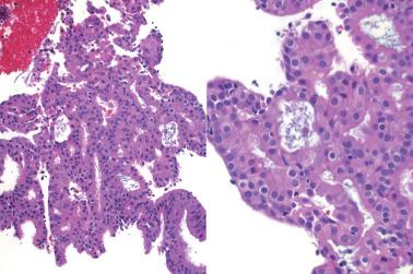 Fig. 7.16, Ciliated (tubal) metaplasia. Occasionally examples show closely packed glands (left). The bland cytologic features with focal ciliation (right) support a benign process.