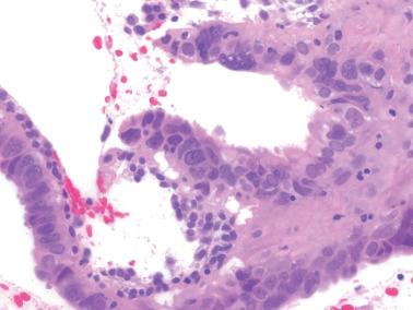 Fig. 7.17, Ciliated (tubal) metaplasia with cytologic atypia. Individual cells show cytologic atypia and a few atypical cells are multinucleate. Cilia are best seen to the right of center.