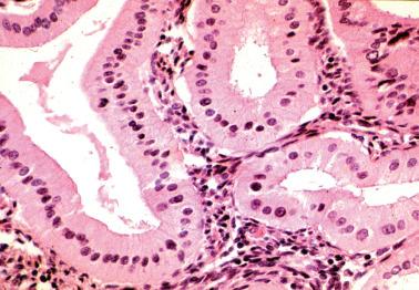 Fig. 7.18, Eosinophilic cell metaplasia. The endometrial glands are lined by nonciliated cells with abundant oxyphilic cytoplasm. The nuclei occupy the middle of the cell, a feature sometimes present.