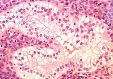 Fig. 7.19, Clear cell metaplasia in a nonpregnant patient.