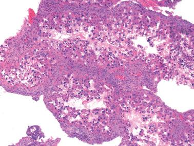 Fig. 7.20, Arias-Stella reaction (ASR). This florid example would raise the differential with clear cell carcinoma.