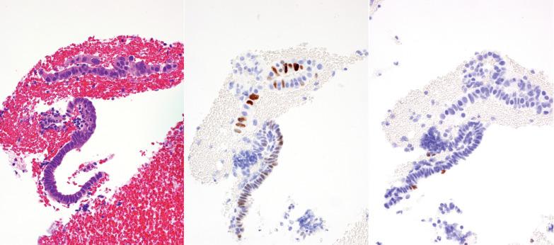 Fig. 7.2, Reactive atypia of endometrial surface epithelium. Left: Focal nuclear enlargement and hyperchromasia are seen in the epithelial fragment at the top of the figure. Wild-type p53 expression (center panel) and very focal ki-67 staining (right panel) indicate a non-neoplastic process.