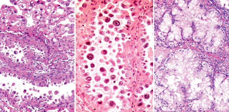 Fig. 7.21, Arias-Stella reaction (ASR) and clear cell change in pregnancy. Left: Typical ASR; some cells (upper part of panel) have clear cytoplasm. Center: Arias-Stella reaction showing cells of hobnail type and an unusual degree of nuclear atypia. Right: Extensive clear cell change in a pregnant woman.