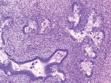 Fig. 7.22, Arias-Stella like reaction. In comparison to ASR in pregnancy, the alterations seen in non-pregnant patients (thus ASR like) more often shows focal alteration within individual gland(s).