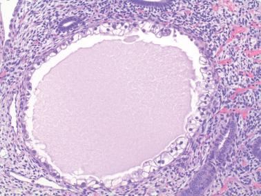 Fig. 7.23, Arias-Stella-like reaction. The cytoplasmic clarity can be striking with appreciable nuclear atypia absent.