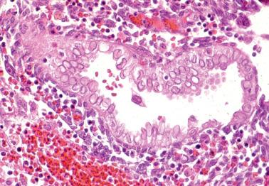 Fig. 7.24, Optically clear nuclei within endometrial glandular cells, a feature associated with pregnancy.