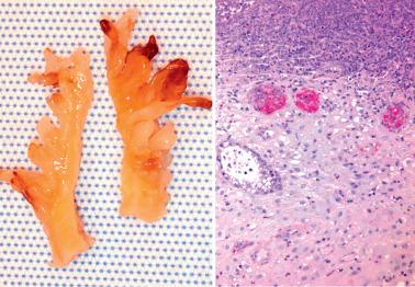 Fig. 7.25, Decidual pseudopolyp of pregnancy. Left: The endometrium is thickened by multiple small polyps. Right: High-power view of a decidual pseudopolyp that prolapsed into the cervix clinically mimicking an endocervical polyp, a typical presentation. Note decidualized stroma, a benign endometrial gland, and an inflammatory infiltrate on its surface.