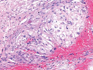 Fig. 7.26, Decidual tissue in a pregnant woman. Many of the cells have a signet-ring-like appearance due to the presence of large cytoplasmic vacuoles.