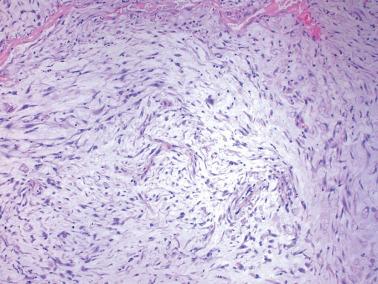 Fig. 7.27, Decidua. Occasionally the decidualized cells assume a spindle morphology and are associated with a myxoid matrix.