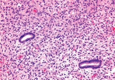 Fig. 7.28, Effects of oral contraceptives or hormone replacement treatment. The glands are reduced in number and size and appear inactive. The stromal cells are partly decidualized.