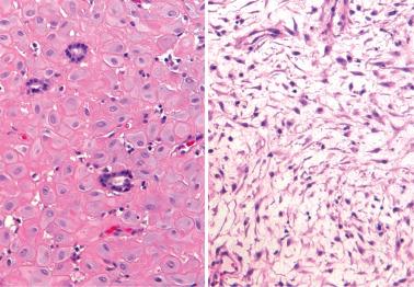 Fig. 7.29, Endometrial changes related to progesterone-releasing intrauterine contraceptive device. Left: Note prominent decidual reaction and small inactive glands. Right: In other areas, the stroma shows a striking myxoid change.