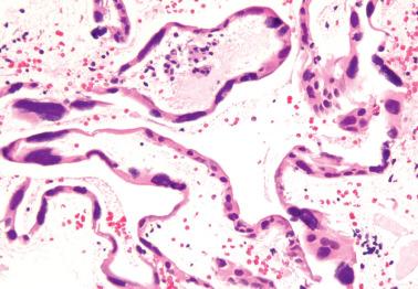 Fig. 7.30, Endometrial surface epithelium showing cells with bizarre nuclear features with smudged chromatin as described in women using exogenous hormones (see text).