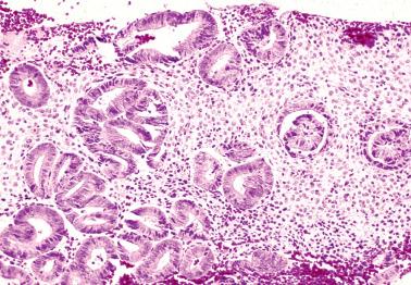 Fig. 7.3, Curettage-related crowding and telescoping of endometrial glands.