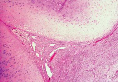 Fig. 7.31, Nodules of hyaline cartilage in the superficial myometrium.