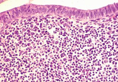 Fig. 7.33, Chronic endometritis. A dense mixed chronic inflammatory infiltrate is present. A vague germinal center is present on the left.