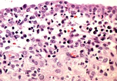 Fig. 7.34, Chronic endometritis in a patient with documented salpingitis. In addition to plasma cells, neutrophils are present and infiltrate the surface epithelium.