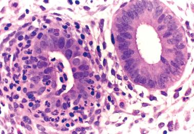 Fig. 7.35, Focal necrotizing endometritis. One endometrial gland is partly destroyed by a mixed inflammatory infiltrate but without plasma cells.