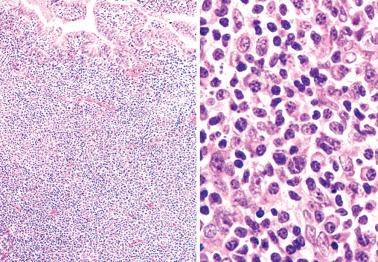 Fig. 7.36, Florid reactive lymphoid hyperplasia (lymphoma-like lesion). Left: Except for the surface epithelium, the endometrium is completely replaced by a dense lymphoid infiltrate. Right: High-power view of the infiltrate reveals a mixed population of lymphocytes, plasma cells, and immunoblasts.