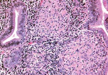 Fig. 7.37, Tuberculous endometritis.