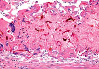 Fig. 7.38, Changes secondary to thermal ablation. Note characteristic greenish-brown hematoidin-like pigment. Black (carbon) pigment (not shown) may also be present in such cases.