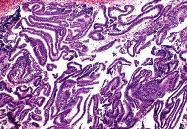 Fig. 7.4, Curettage-related fragmentation and crowding of mostly endometrial surface epithelium.