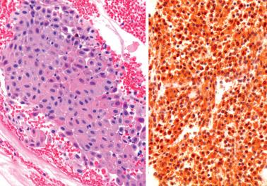 Fig. 7.41, Histiocytic nodule in an endometrial curettage specimen (left: H&E; right: CD68 immunostain).