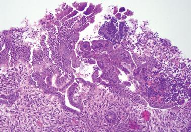 Fig. 7.42, Reactive surface epithelial changes in a patient with an intrauterine device. Surface papillarity is conspicuous and underlying endometrial stroma demonstrates a striking spindled morphology.