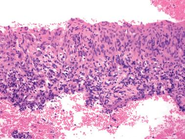 Fig. 7.43, Synovial-like metaplasia. Palisading of histiocytes along the endometrial surface creates an appearance which has been likened to a synovial membrane.