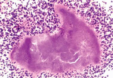 Fig. 7.44, Colony of actinomyces (sulfur granule) in a patient with actinomycotic endometritis.