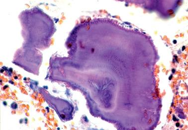 Fig. 7.45, Pseudoactinomycotic radiate granule in a patient with an intrauterine device. Note laminated structure.