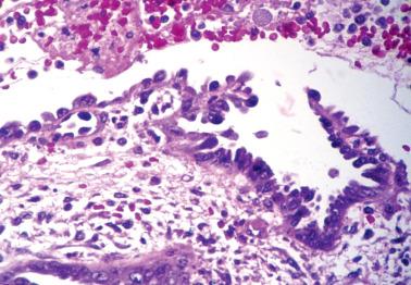 Fig. 7.5, Post-curettage reactive atypia of endometrial surface epithelium. Some of the cells are of hobnail type.