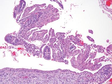 Fig. 7.6, Syncytial papillary change (SPC). This example shows a predominantly papillary pattern. The characteristic eosinophilic cytoplasm and focal stromal breakdown are also seen.