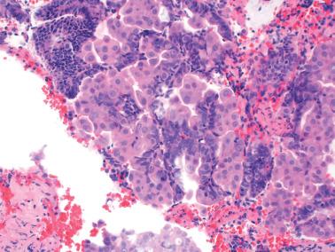 Fig. 7.7, Syncytial papillary change. Small tufts of cells with abundant eosinophilic cytoplasm are intermixed with aggregates of stroma showing breakdown.