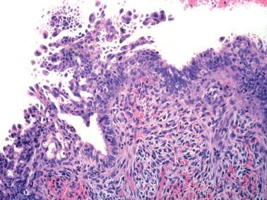 Fig. 7.8, Syncytial papillary change. This unusual example shows many detached clusters of cells and individual cells. Limited cytologic atypia is also present.