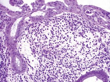 Fig. 7.9, Syncytial papillary change. This example shows a predominantly plaque-like proliferation with only limited papillarity.