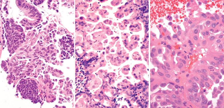 Fig. 7.10, Syncytial papillary change (SPC) in a menstrual endometrium. Left: SPC surrounds two nests of compacted endometrial stromal cells. Center: Stroma free papillae are composed of syncytial eosinophilic cells with bland nuclear features; nuclear debris is also present. Right: SPC with reactive atypia.