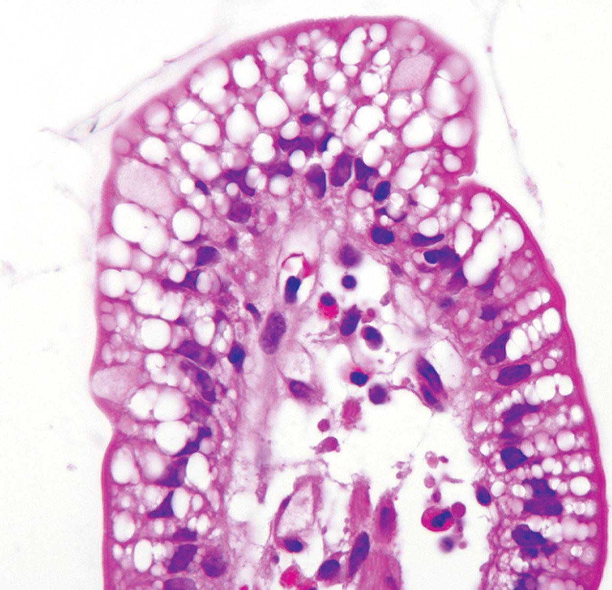 Figure 5.12, “Lipid hang-up.” Duodenal biopsy showing vacuolization of the enterocyte epithelium. These are physiologically normal enterocytes that retain lipid after a meal.