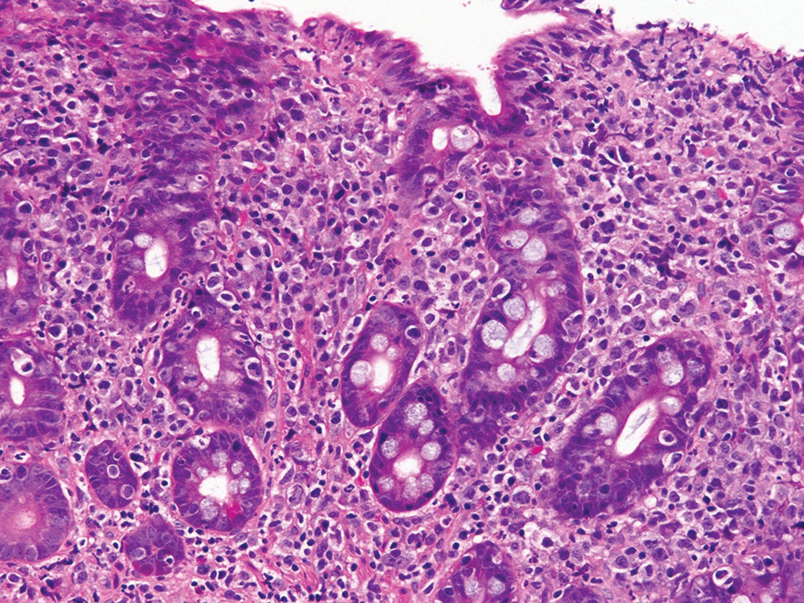 Figure 5.5, Enteropathy-associated T-cell lymphoma. The duodenal biopsy shows marked villous blunting with expansion of the lamina propria by a monomorphic population of atypical medium to large lymphoid cells.