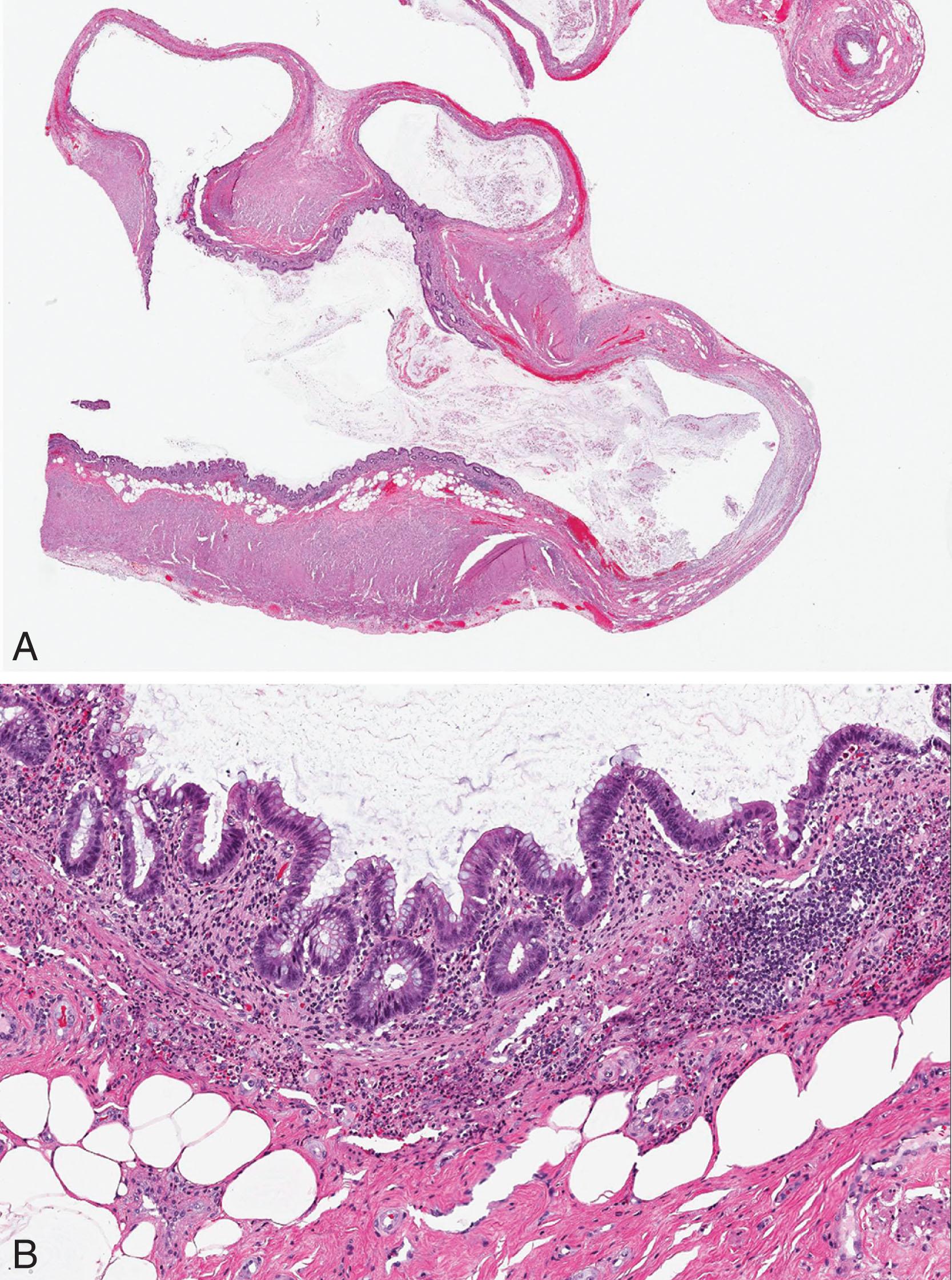 Figure 8.1, A , Appendiceal diverticular disease. The appendiceal tip shows numerous outpouchings composed of mucosa and submucosal tissue with attenuation of the corresponding muscularis propria. B , Higher magnification of the mucosa shows normal epithelial lining with intact lamina propria and muscularis mucosae.
