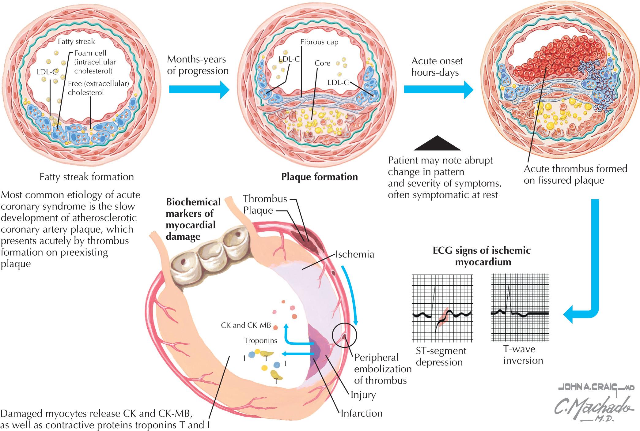 FIG 20.1, Pathophysiology of Acute Coronary Syndromes.